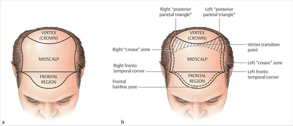Clinical diagram identifying the vertex, midscalp, frontal region, hairline and transition points
