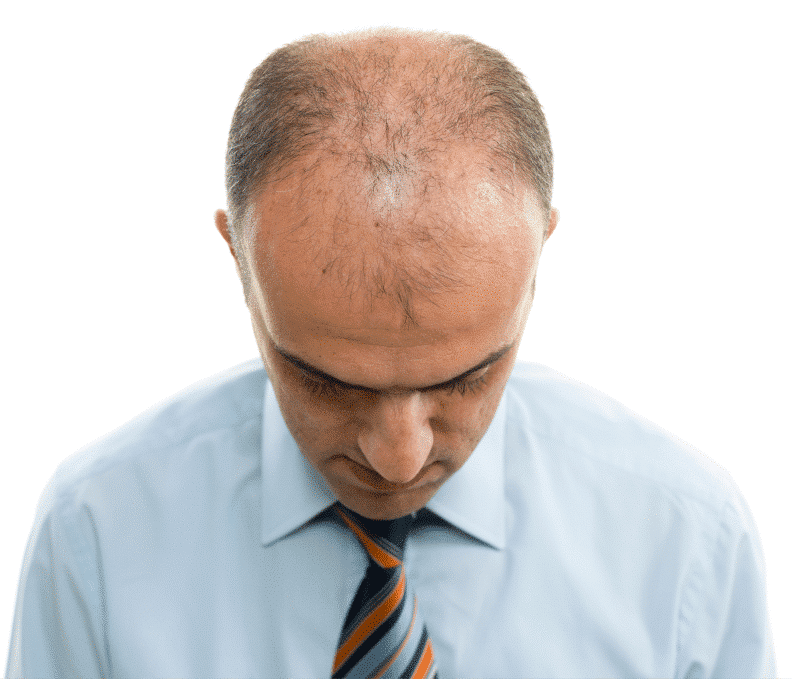Examples of male and female androgenetic alopecia patterns