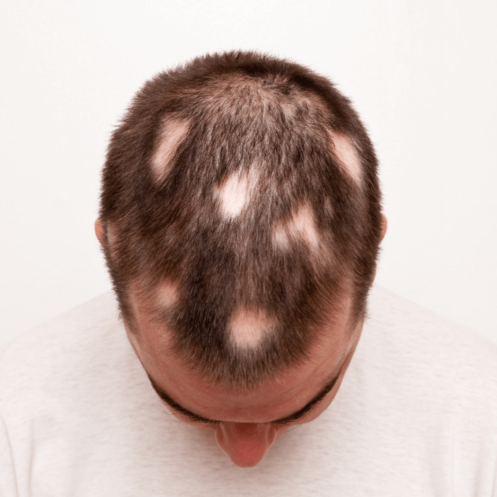 how-many-types-of-alopecia-areata-are-there-trichology