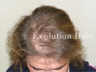 Effective natural hair loss treatment